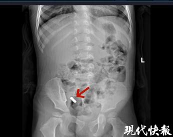 磁力珠吃到肚子里多久有反应=磁力珠误食3颗有排出来的案例吗?